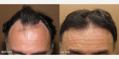Man treated with ARTAS Robotic Hair Transplant, Hair Transplant - Man treated with Hair Transplant, ARTAS Robotic Hair Transplant