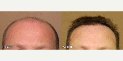 Man treated with ARTAS Robotic Hair Transplant, Hair Transplant - Man treated with Hair Transplant, ARTAS Robotic Hair Transplant