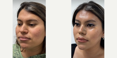 Woman treated with Buccal Fat Removal - Woman treated with Facial Feminization Surgery through coronal approach to a brow bone and supraorbital bone reduction, a direct Brow Lift, Neck Lift, Facelift, Jaw Reduction, T Genioplasty, Buccal Fat Removal, and a closed Rhinoplasty. Patient is shown before and 6 months post-op.