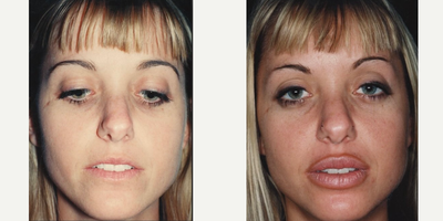 25-34 year old woman treated with Lip Surgery - FATMA (fat transfer & mucosal advancement) are actually 2 procedures rolled into one. This surgery produces permanently fuller lips with your own tissue, combining rearrangement of the tissue via strategically located V- Y plasties just inside your mouth with fat transfer. These procedures act by working synergistically to create fuller lips that either technique cannot produce on their own.