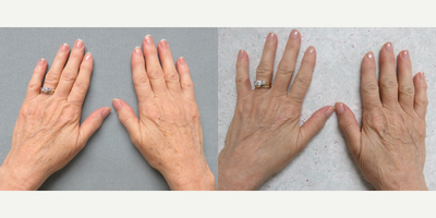 45-54 year old woman treated with BroadBand Light (BBL) - 45-54 year old woman treated with BroadBand Light (BBL)