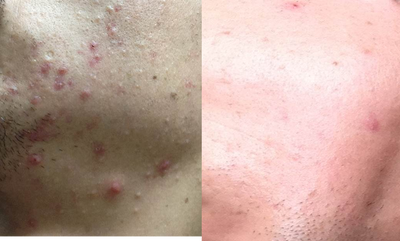 Accutane - 
	33 year old patient suffering from cystic acne breakouts on his face. Pictures show the patient after 3 months of taking Accutane.
