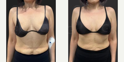 55-64 year old woman treated with Breast Lift, Breast Implants, Breast Augmentation - 55-64 year old woman treated with Breast Lift, Breast Implants, Breast Augmentation