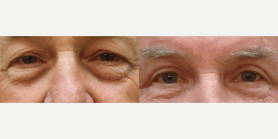 Man treated with Eyelid Surgery - Man treated with Eyelid Surgery