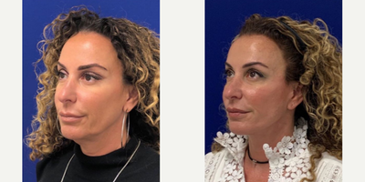 49 year old woman treated with Lower Facelift - 49 year old woman treated with Lower Facelift with Neck Lift, Fat Transfer, Upper Eyelid Blepharoplasty and CO2 Laser Skin Resurfacing. Patient is shown before and 10 months post op.