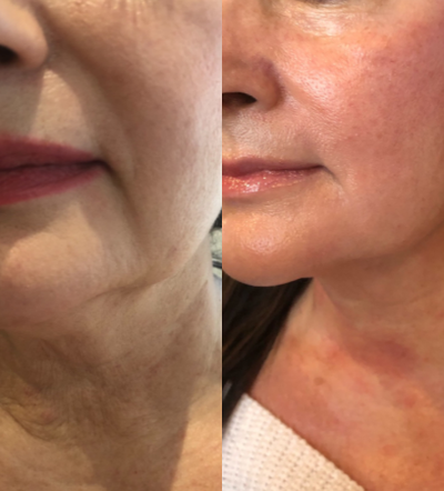 45-54 year old woman treated with Forma - Results after Forma Skin Tightening treatment.
