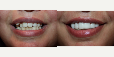 25-34 year old woman treated with Lumineers - This patient did not want to have orthodontic therapy as recommended as primary treatment. A treatment plan which utilized an extraction of the displaced maxillary right canine and 9 Lumineers was presented as an alternate treatment. This was the treatment desired by the patient, and she wanted a very white shade of porcelain and proceeded with this course of treatment.
