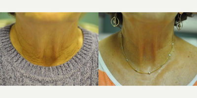 55-64 year old woman treated with TriPollar - Loose skin at the base of neck. Before and after TriPollar RF treatment.