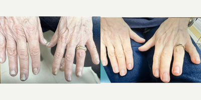 65-74 year old woman treated with Laser Toenail Fungus Removal - Before and after 3 laser fungus removal treatments on the fingernails.