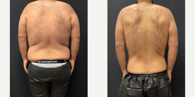 25-34 year old man treated with Semaglutide - 100lbs lost on Semaglutide