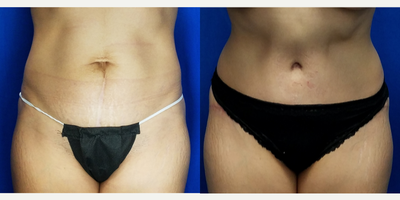 35-44 year old woman treated with Tummy Tuck - 41 year old female who is 2 months after a tummy tuck as part of a mommy makeover. She had a drainless tummy tuck. Her height is 5 feet and her weight is 113 lbs. Her lower vertical scar was replaced by a lower scar hidden underneath her underwear.