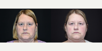 55-64 year old woman treated with ArteFill - 60 year old female received two (2) syringes of Bellafill to her nasolabial folds and marionettes; photos depict the patient's results 3 months post-treatment.
