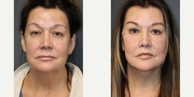 Enigmalift full facial rejuvenation. - Enigmalift upper and lower eyelids with deep plane face and neck lift plus laser.