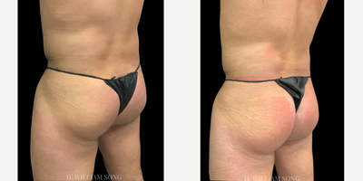 25-34 year old man treated with truFlex - Non-surgical Butt lift with truSculpt Flex
