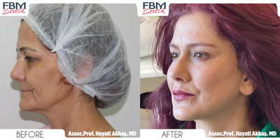45-54 year old woman treated with Deep Plane Facelift, Eyelid Surgery, Mini Neck Lift, Facial Fat Transfer, Lip Lift - 45-54 year old woman treated with Deep Plane Facelift, Eyelid Surgery, Mini Neck Lift, Facial Fat Transfer, Lip Lift