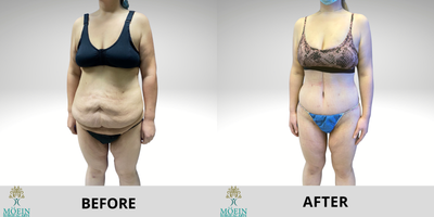 45-54 year old woman treated with Panniculectomy - Our lovely patient who underwent panniculectomy.