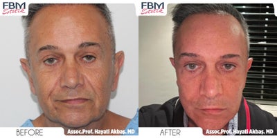55-64 year old man treated with Deep Plane Facelift, Neck Lift, Eyelid Surgery, Facial Fat Transfer - .