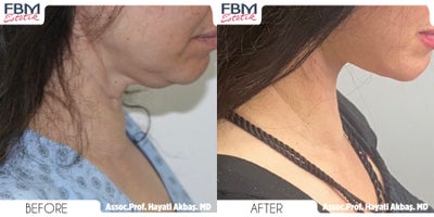 35-44 year old woman treated with Mini Neck Lift - 35-44 year old woman treated with Mini Neck Lift