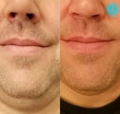 Man treated with Evolve - Man treated with Evolve
