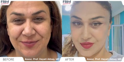 35-44 year old man treated with Deep Plane Facelift - .
