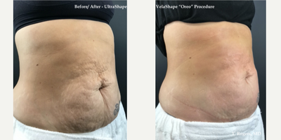 45-54 year old woman treated with UltraShape - 45-54 year old woman treated with UltraShape