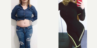 18-24 year old woman treated with Tummy Tuck, Liposuction, Brazilian Butt Lift - Excellent outcome after full body intense liposuction including abdomen, waist, laterals, upper and lower back plus DOMINICAN BUTT LIFT by Mallol getting better volume, contour and butt projection.
