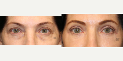 Enigmalift Upper and Lower Eyelid Surgery - Enigmalift upper and lower eyelid surgery with laser resurfacing and fat transfer.
