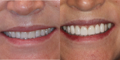 45-54 year old woman treated with Da Vinci Veneers - Patient stated that her teeth looked worn and dark. She treated with&nbsp;Da Vinci Veneers.