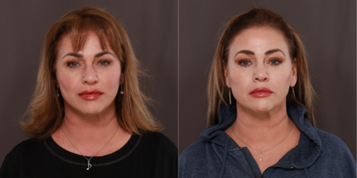 45-54 year old man treated with MACS Facelift - Macslift