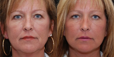 Woman treated with Juvederm - Injectable Fillers