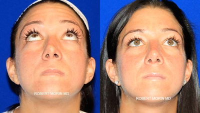 25 year old woman treated with Revision Rhinoplasty - A complex revision rhinoplasty was performed on this 25 year old woman who was extremely unhappy with her crooked rhinoplasty result performed by another surgeon. The patient's nose and septum were straightened using several surgical techniques including spreader grafting to the nasal dorsum. The result is a straight nose with a beautifully defined and symmetric nasal tip.