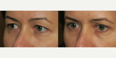 Woman treated with Eyelid Surgery - Woman treated with Eyelid Surgery