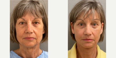 68 year old woman treated with Facelift, SMAS Facelift, Neck Lift, Brow Lift, Eyelid Surgery - 68 year old woman treated with Facelift, SMAS Facelift, Neck Lift, Brow Lift, and Eyelid Surgery through upper and lower blepharoplasty.