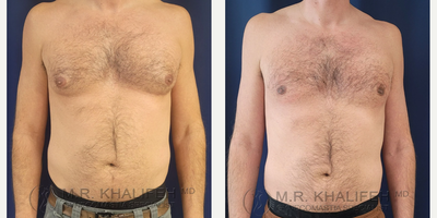 Man treated with Gynecomastia Surgery - Man treated with Gynecomastia Surgery