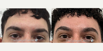 25-34 year old man treated with Forehead Reduction - 25-34 year old man treated with forehead contouring along with scalp advancement.
