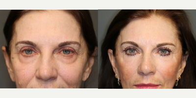 Enigmalift, deep plane vidalift, lovelift. - Deep plane face and neck lift with scarless lower eye bag removal, lip lift, fat transfer, laser resurfacing.