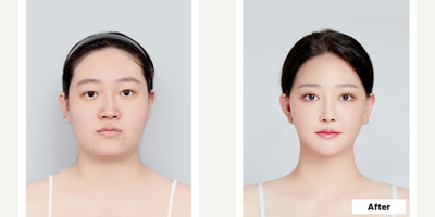 25-34 year old woman treated with V Line Surgery - Two Jaw Surgery + 3 Point Facial Contouring + Non-Incisional Double Eyelid Surgery + Rhinoplasty + Mini Face Lifting