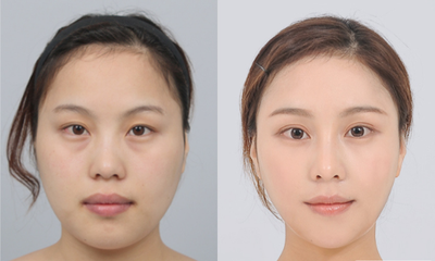 25-34 year old woman treated with Jaw Reduction - DA Smile Double Jaw Surgery