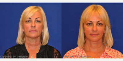Laser Treatment - Laser Treatment