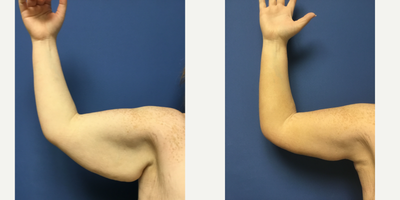 18-24 year old woman treated with Arm Lift - Brachioplasty performed by Dr. Keith Hodge of Monarch Plastic Surgery.