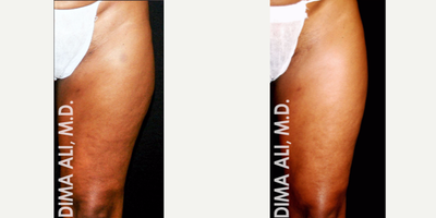 45-54 year old woman treated with Venus Freeze - This patient received 8 treatments of Venus Freeze for the thighs. Venus Freeze is suitable for various face and body applications including circumference reduction, cellulite improvement, skin tightening and wrinkle reduction. Here we reduced the appearance of stretch marks and cellulite while enhancing the shape of the thighs reducing circumference around the hip area.