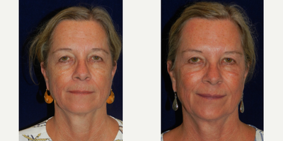 55-64 year old woman treated with DefenAge - 60 year old woman treated with Morpheus8 while using DefenAge skincare.
