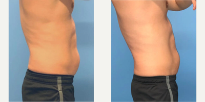 36 year old man treated with CoolTone - 36 year old male underwent a total of 4 CoolTone cycles (in a 2 week span) in the abdomen area.