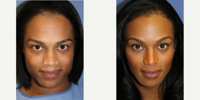 Woman treated with Facial Feminization Surgery - Woman treated with Facial Feminization Surgery