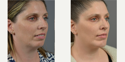 35-44 year old woman treated with Chin Implant - This patient had a goal of making her profile more symmetrical. Dr. Marotta achieved this result with a chin implant and liposuction of the neck.