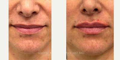 Woman treated with Lip Fillers - Woman treated with Lip Fillers using 1 syringe of Volbella
