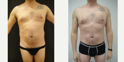 35-44 year old man treated with Liposonix - Liposonix treatment of the abdomen and flanks