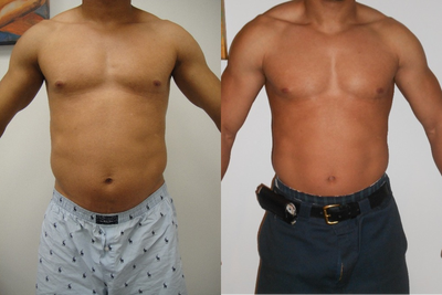 35-44 year old man treated with Liposonix - Liposonix treatment of the abdomen and flanks