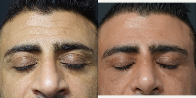 35-44 year old man treated with Eyelid Surgery - Eyelid Surgery - 50 days Post-Operative