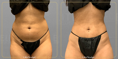 25-34 year old woman treated with AirSculpt - Take a look at thispatients back and belly fat reduction just three months after her treatment. While AirSculpt always provides instant results, they will continue to improve until six months after the procedure!